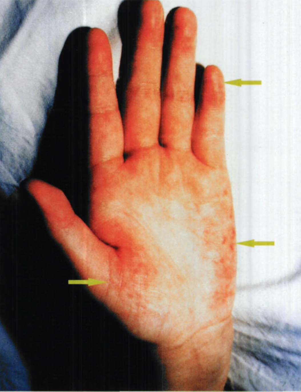 Finger necrosis with eosinophilia and symmetrical occlusion of the ...